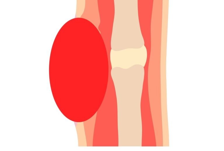 Illustration of a soft tissue injury showing swelling and damage to the muscles and tissues surrounding the knee joint.